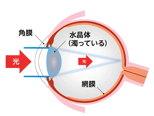 白内障の目