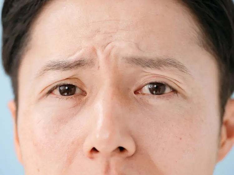 眼瞼下垂